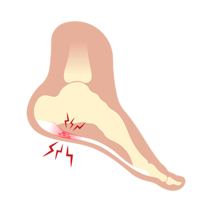 Ostroga piętowa (osteofit)