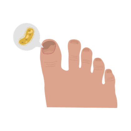 Grzybica paznokci (grzybica paznokci) i grzybica stóp (grzybica stóp)